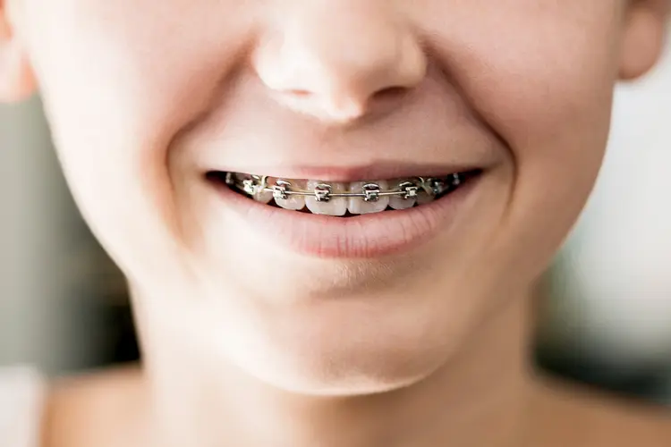 Braces and Clear Aligners